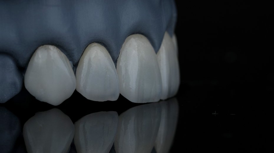 IPS EMAX veneer, Golden Dental